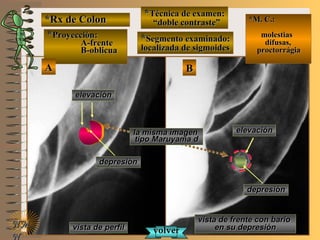 vista de perfilvista de perfil
vista de frente con bariovista de frente con bario
en su depresiónen su depresión
*Rx de Colon*Rx de Colon
**Técnica de examen:Técnica de examen:
““doble contraste”doble contraste”
**Segmento examinado:Segmento examinado:
localizada de sigmoideslocalizada de sigmoides
E ME M
UNTUNT
*M. C.:*M. C.:
molestiasmolestias
difusas,difusas,
proctorrágiaproctorrágia
NMNM
N
elevaciónelevación
depresióndepresión
elevaciónelevación
depresióndepresión
la misma imagenla misma imagen
tipo Maruyama dtipo Maruyama d
volvervolver
**Proyección:Proyección:
A-frenteA-frente
B-oblicuaB-oblicua
BBAA
 