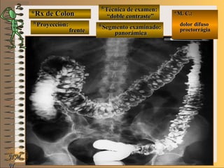 *Rx de Colon*Rx de Colon
**Proyección:Proyección:
**Técnica de examen:Técnica de examen:
**Segmento examinado:Segmento examinado:
E ME M
UNTUNT
*M. C.:*M. C.:
dolor difusodolor difuso
proctorrágiaproctorrágia
NMNM
N
frentefrente
““doble contraste”doble contraste”
panorámicapanorámica
 