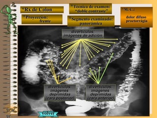 *Rx de Colon*Rx de Colon
**Proyección:Proyección:
frentefrente
**Técnica de examen:Técnica de examen:
““doble contraste”doble contraste”
**Segmento examinado:Segmento examinado:
panorámicapanorámica
E ME M
UNTUNT
*M. C.:*M. C.:
dolor difusodolor difuso
proctorrágiaproctorrágia
NMNM
N
divertículos:divertículos:
imágenes de adiciónimágenes de adición
divertículos:divertículos:
imágenesimágenes
deprimidasdeprimidas
(cara posterior)(cara posterior)
divertículos:divertículos:
imágenesimágenes
deprimidasdeprimidas
(cara anterior)(cara anterior)
volvervolver
 