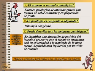 A-A-El examen es normal o patológico?El examen es normal o patológico?
Examen patológico de intestino grueso conExamen patológico de intestino grueso con
técnica de doble contraste y en proyeccióntécnica de doble contraste y en proyección
de frentede frente
B-B-La patología es congénita o adquirida?La patología es congénita o adquirida?
Patología congénitaPatología congénita
C-C-Puede describir la o las imágenes patológicas?Puede describir la o las imágenes patológicas?
**OpciónOpción
de volverde volver
a ver lasa ver las
imágenesimágenes
Se identifica una alteración de posición delSe identifica una alteración de posición del
intestino grueso ya que el mismo se encuentraintestino grueso ya que el mismo se encuentra
casi en su totalidad a la izquierda de la líneacasi en su totalidad a la izquierda de la línea
media (hemiabdomen izquierdo) por un viciomedia (hemiabdomen izquierdo) por un vicio
de rotaciónde rotación
**Opción avanzada para volver a ver las imágenes con reparosOpción avanzada para volver a ver las imágenes con reparos
NMNM
D. F. M.D. F. M.
UNTUNT
E ME M
UNTUNT
 