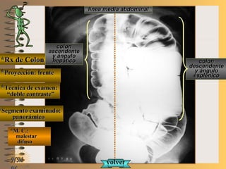 E ME M
UNTUNT
*Rx de Colon*Rx de Colon
**Proyección: frenteProyección: frente
**Técnica de examen:Técnica de examen:
““doble contraste”doble contraste”
**Segmento examinado:Segmento examinado:
panorámicopanorámico
*M. C.:*M. C.:
malestarmalestar
difusodifuso
NMNM
línea media abdominallínea media abdominal
coloncolon
ascendenteascendente
y ánguloy ángulo
hepáticohepático coloncolon
descendentedescendente
y ánguloy ángulo
esplénicoesplénico
volvervolver
 
