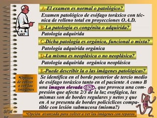 A-A-El examen es normal o patológico?El examen es normal o patológico?
Examen patológico de esófago toráxico con téc-Examen patológico de esófago toráxico con téc-
nica de relleno total en proyecciones O.A.D.nica de relleno total en proyecciones O.A.D.
B-B-La patología es congénita o adquirida?La patología es congénita o adquirida?
Patología adquiridaPatología adquirida
D-D-La misma es neoplásica o no neoplásica?La misma es neoplásica o no neoplásica?
**OpciónOpción
de volverde volver
a ver lasa ver las
imágenesimágenes
Patología adquirida orgánica neoplásicaPatología adquirida orgánica neoplásica
E-E-Puede describir la o las imágenes patológicas?Puede describir la o las imágenes patológicas?
Se identifica en el borde posterior de tercio medioSe identifica en el borde posterior de tercio medio
de esófago toráxico tanto en el paciente A como Bde esófago toráxico tanto en el paciente A como B
unauna imagen elevadaimagen elevada UNTUNT , que provoca una com-, que provoca una com-
presión que afecta 2/3 de la luz esofágica, laspresión que afecta 2/3 de la luz esofágica, las
mismas son de bordes regulares y netos y quemismas son de bordes regulares y netos y que
en A se presenta de bordes policíclicos compa-en A se presenta de bordes policíclicos compa-
tible con lesión submucosa (mioma?)tible con lesión submucosa (mioma?)
NMNM **Opción avanzada para volver a ver las imágenes con reparosOpción avanzada para volver a ver las imágenes con reparos
C-C-Dicha patología es orgánica, funcional o mixta?Dicha patología es orgánica, funcional o mixta?
Patología adquirida orgánicaPatología adquirida orgánica
D. F. M.D. F. M.
UNTUNT
E ME M
UNTUNT
 
