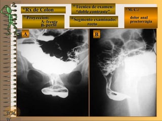 *Rx de Colon*Rx de Colon
**Proyección:Proyección:
A-A-
B-B-
**Técnica de examen:Técnica de examen:
**Segmento examinado:Segmento examinado:
E ME M
UNTUNT
*M. C.:*M. C.:
dolor analdolor anal
proctorrágiaproctorrágia
NMNM
N
BBAA
frentefrente
perfilperfil
““doble contraste”doble contraste”
rectorecto
 