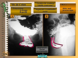 *Rx de Colon*Rx de Colon
**Proyección:Proyección:
A-frenteA-frente
B-perfilB-perfil
**Técnica de examen:Técnica de examen:
““doble contraste”doble contraste”
**Segmento examinado:Segmento examinado:
rectorecto
E ME M
UNTUNT
*M. C.:*M. C.:
dolor analdolor anal
proctorrágiaproctorrágia
NMNM
N
BBAA
segmentosegmento
rectalrectal
prolapsadoprolapsado
volvervolver
 