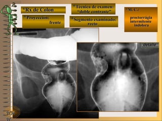 *Rx de Colon*Rx de Colon
**Proyección:Proyección:
**Técnica de examen:Técnica de examen:
**Segmento examinado:Segmento examinado:
E ME M
UNTUNT
*M. C.:*M. C.:
proctorrágiaproctorrágia
intermitenteintermitente
indoloraindolora
NMNM
N
detalledetalle
frentefrente
““doble contraste”doble contraste”
rectorecto
 