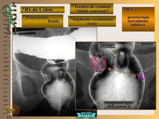 *Rx de Colon*Rx de Colon
**Proyección:Proyección:
frentefrente
**Técnica de examen:Técnica de examen:
““doble contraste”doble contraste”
**Segmento examinado:Segmento examinado:
rectorecto
E ME M
UNTUNT
*M. C.:*M. C.:
proctorrágiaproctorrágia
intermitenteintermitente
indoloraindolora
NMNM
N
detalledetalle
imágenesimágenes tipotipo
Maruyama bMaruyama b
cánulacánula
volvervolver
 