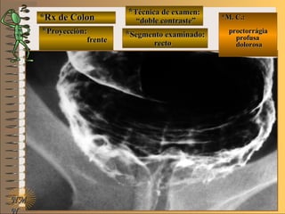 *Rx de Colon*Rx de Colon
**Proyección:Proyección:
**Técnica de examen:Técnica de examen:
**Segmento examinado:Segmento examinado:
E ME M
UNTUNT
*M. C.:*M. C.:
proctorrágiaproctorrágia
profusaprofusa
dolorosadolorosa
NMNM
N
frentefrente
““doble contraste”doble contraste”
rectorecto
 