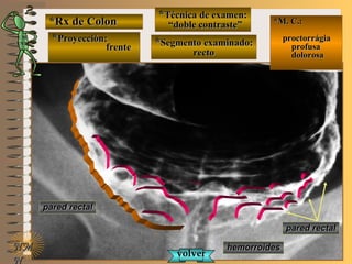 *Rx de Colon*Rx de Colon
**Proyección:Proyección:
frentefrente
**Técnica de examen:Técnica de examen:
““doble contraste”doble contraste”
**Segmento examinado:Segmento examinado:
rectorecto
E ME M
UNTUNT
*M. C.:*M. C.:
proctorrágiaproctorrágia
profusaprofusa
dolorosadolorosa
NMNM
N
hemorroideshemorroides
volvervolver
pared rectalpared rectal
pared rectalpared rectal
 