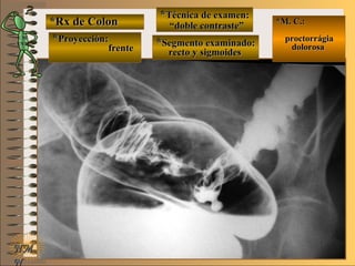 *Rx de Colon*Rx de Colon
**Proyección:Proyección:
**Técnica de examen:Técnica de examen:
**Segmento examinado:Segmento examinado:
E ME M
UNTUNT
*M. C.:*M. C.:
proctorrágiaproctorrágia
dolorosadolorosa
NMNM
N
frentefrente
““doble contraste”doble contraste”
recto y sigmoidesrecto y sigmoides
 