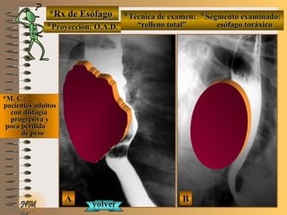 E ME M
UNTUNT
NMNM
*Rx de Esófago*Rx de Esófago
**Proyección: O.A.D.Proyección: O.A.D.
**Técnica de examen:Técnica de examen:
““relleno total”relleno total”
**Segmento examinado:Segmento examinado:
esófago toráxicoesófago toráxico
*M. C.:*M. C.:
pacientes adultospacientes adultos
con disfagiacon disfagia
progresiva yprogresiva y
poca pérdidapoca pérdida
de pesode peso
AA BB
volvervolver
 