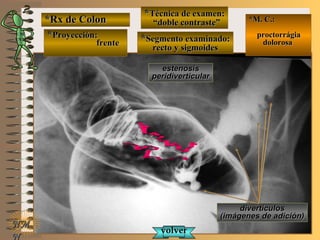 *Rx de Colon*Rx de Colon
**Proyección:Proyección:
frentefrente
**Técnica de examen:Técnica de examen:
““doble contraste”doble contraste”
**Segmento examinado:Segmento examinado:
recto y sigmoidesrecto y sigmoides
E ME M
UNTUNT
*M. C.:*M. C.:
proctorrágiaproctorrágia
dolorosadolorosa
NMNM
N
divertículosdivertículos
(imágenes de adición)(imágenes de adición)
estenosisestenosis
peridiverticularperidiverticular
volvervolver
 