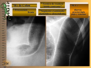 *Rx de Colon*Rx de Colon
**Proyección:Proyección:
**Técnica de examen:Técnica de examen:
**Segmento examinado:Segmento examinado:
E ME M
UNTUNT
*M. C.:*M. C.:
diarreadiarrea
proctorrágiaproctorrágia
pujo y tenesmopujo y tenesmo
NMNM
N
frentefrente
““doble contraste”doble contraste”
sigmoides y descendentesigmoides y descendente
 