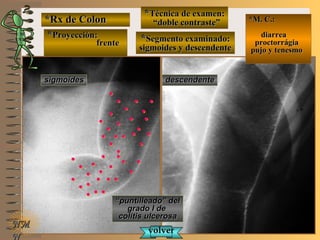 *Rx de Colon*Rx de Colon
**Proyección:Proyección:
frentefrente
**Técnica de examen:Técnica de examen:
““doble contraste”doble contraste”
**Segmento examinado:Segmento examinado:
sigmoides y descendentesigmoides y descendente
E ME M
UNTUNT
*M. C.:*M. C.:
diarreadiarrea
proctorrágiaproctorrágia
pujo y tenesmopujo y tenesmo
NMNM
N
““puntilleado” delpuntilleado” del
grado I degrado I de
colitis ulcerosacolitis ulcerosa
sigmoidessigmoides descendentedescendente
volvervolver
 