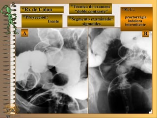 *Rx de Colon*Rx de Colon
**Proyección:Proyección:
**Técnica de examen:Técnica de examen:
**Segmento examinado:Segmento examinado:
E ME M
UNTUNT
*M. C.:*M. C.:
proctorrágiaproctorrágia
indoloraindolora
intermitenteintermitente
NMNM
N
BBAA
frentefrente
““doble contraste”doble contraste”
sigmoidessigmoides
 