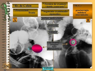 *Rx de Colon*Rx de Colon
**Proyección:Proyección:
frentefrente
**Técnica de examen:Técnica de examen:
““doble contraste”doble contraste”
**Segmento examinado:Segmento examinado:
sigmoidessigmoides
E ME M
UNTUNT
*M. C.:*M. C.:
proctorrágiaproctorrágia
indoloraindolora
intermitenteintermitente
NMNM
N
BBAA
pólipo pediculadopólipo pediculado
pedículopedículo
cabezacabeza
volvervolver
la mismala misma
imagenimagen
tipotipo
Maruyama aMaruyama a
 