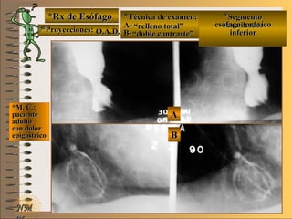 NMNM
*Rx de Esófago*Rx de Esófago
**Proyecciones:Proyecciones:
**Técnica de examen:Técnica de examen:
A-A-
B-B-
**SegmentoSegmento
examinado:examinado:
*M. C.:*M. C.:
pacientepaciente
adultoadulto
con dolorcon dolor
epigástricoepigástrico
AA
BB
E ME M
UNTUNT O.A.D.O.A.D.
““relleno total”relleno total”
““doble contraste”doble contraste”
esófago toráxicoesófago toráxico
inferiorinferior
 