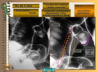 *Rx de Colon*Rx de Colon
**Proyección:Proyección:
frentefrente
**Técnica de examen:Técnica de examen:
““doble contraste”doble contraste”
**Segmento examinado:Segmento examinado:
anastomosis entreanastomosis entre
ángulo hepático e ileonángulo hepático e ileon
E ME M
UNTUNT
*M. C.:*M. C.:
antecedentesantecedentes
quirúrgicosquirúrgicos
NMNM
N
detalledetalle
coloncolon
ileonileon
aa
nn
aa
ss
tt
oo
mm
oo
ss
ii
ss
bolsabolsa
ciegaciega
dede
ileonileon
volvervolver
 