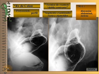 detalledetalle
*Rx de Colon*Rx de Colon
**Proyección:Proyección:
**Técnica de examen:Técnica de examen:
**Segmento examinado:Segmento examinado:
E ME M
UNTUNT
*M. C.:*M. C.:
distensióndistensión
abdominal,abdominal,
melenamelena
NMNM
N
perfilperfil
““doble contraste”doble contraste”
recto y sigmoidesrecto y sigmoides
 