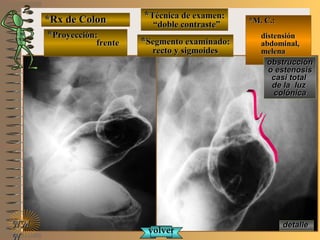 detalledetalle
*Rx de Colon*Rx de Colon
**Proyección:Proyección:
frentefrente
**Técnica de examen:Técnica de examen:
““doble contraste”doble contraste”
**Segmento examinado:Segmento examinado:
recto y sigmoidesrecto y sigmoides
E ME M
UNTUNT
*M. C.:*M. C.:
distensióndistensión
abdominal,abdominal,
melenamelena
NMNM
N
obstrucciónobstrucción
o estenosiso estenosis
casi totalcasi total
de la luzde la luz
colónicacolónica
volvervolver
 