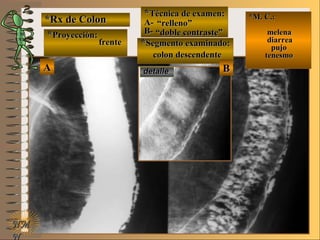 AA
*Rx de Colon*Rx de Colon
**Proyección:Proyección:
**Técnica de examen:Técnica de examen:
A-A-
B-B-
**Segmento examinado:Segmento examinado:
E ME M
UNTUNT
*M. C.:*M. C.:
melenamelena
diarreadiarrea
pujopujo
tenesmotenesmo
NMNM
N
BBdetalledetalle
frentefrente
““relleno”relleno”
““doble contraste”doble contraste”
colon descendentecolon descendente
 