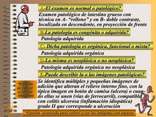 A-A-El examen es normal o patológico?El examen es normal o patológico?
Examen patológico de intestino grueso conExamen patológico de intestino grueso con
técnica en A- “relleno” y en B- doble contraste,técnica en A- “relleno” y en B- doble contraste,
localizada en descendente, en proyección de frentelocalizada en descendente, en proyección de frente
B-B-La patología es congénita o adquirida?La patología es congénita o adquirida?
Patología adquiridaPatología adquirida
C-C- Dicha patología es orgánica, funcional o mixta?Dicha patología es orgánica, funcional o mixta?
**OpciónOpción
de volverde volver
a ver lasa ver las
imágenesimágenes
Patología adquirida orgánicaPatología adquirida orgánica
D-D-La misma es neoplásica o no neoplásica?La misma es neoplásica o no neoplásica?
Patología adquirida orgánica no neoplásicaPatología adquirida orgánica no neoplásica
E-E-Puede describir la o las imágenes patológicas?Puede describir la o las imágenes patológicas?
Se identifica múltiples y pequeñas imágenes deSe identifica múltiples y pequeñas imágenes de
adición que alteran el relieve interno fino, con laadición que alteran el relieve interno fino, con la
típica imagen en botón de camisa (ulcera) o cuan-típica imagen en botón de camisa (ulcera) o cuan-
do ellas se unen (vías de ferrocarril), compatibledo ellas se unen (vías de ferrocarril), compatible
con colitis ulcerosa (inflamación idiopática)con colitis ulcerosa (inflamación idiopática)
grado II que corresponde a ulceracióngrado II que corresponde a ulceración
**Opción avanzada para volver a ver las imágenes con reparosOpción avanzada para volver a ver las imágenes con reparos
NMNM
D. F. M.D. F. M.
UNTUNT
E ME M
UNTUNT
 