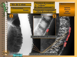 AA
*Rx de Colon*Rx de Colon
**Proyección:Proyección:
frentefrente
**Técnica de examen:Técnica de examen:
A- “relleno”A- “relleno”
B-“doble contraste”B-“doble contraste”
**Segmento examinado:Segmento examinado:
colon descendentecolon descendente
E ME M
UNTUNT
*M. C.:*M. C.:
melenamelena
diarreadiarrea
pujopujo
tenesmotenesmo
NMNM
N
BBdetalledetalle
úlcera en botón de camisaúlcera en botón de camisa
úlceras en vías de ferrocarrilúlceras en vías de ferrocarrilvolvervolver
 