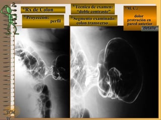 *Rx de Colon*Rx de Colon
**Proyección:Proyección:
**Técnica de examen:Técnica de examen:
**Segmento examinado:Segmento examinado:E ME M
UNTUNT
*M. C.:*M. C.:
dolordolor
protrución enprotrución en
pared anteriorpared anterior
NMNM
N
detalledetalle
perfilperfil
““doble contraste”doble contraste”
colon transversocolon transverso
 