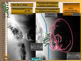 *Rx de Colon*Rx de Colon
**Proyección:Proyección:
perfilperfil
**Técnica de examen:Técnica de examen:
““doble contraste”doble contraste”
**Segmento examinado:Segmento examinado:
colon transversocolon transverso
E ME M
UNTUNT
*M. C.:*M. C.:
dolordolor
protrución enprotrución en
pared anteriorpared anterior
NMNM
N
detalledetalle
asas deasas de
coloncolon
transversotransverso
eventradaseventradas
pliegues apliegues a
través deltravés del
orificioorificio
quirúrgicoquirúrgico
paredpared
muscularmuscular
volvervolver
 