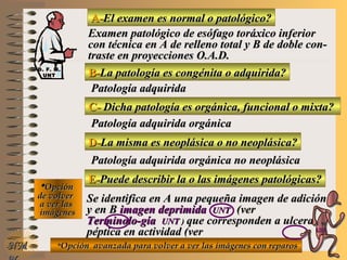 A-A-El examen es normal o patológico?El examen es normal o patológico?
Examen patológico de esófago toráxico inferiorExamen patológico de esófago toráxico inferior
con técnica en A de relleno total y B de doble con-con técnica en A de relleno total y B de doble con-
traste en proyecciones O.A.D.traste en proyecciones O.A.D.
B-B-La patología es congénita o adquirida?La patología es congénita o adquirida?
Patología adquiridaPatología adquirida
C-C- Dicha patología es orgánica, funcional o mixta?Dicha patología es orgánica, funcional o mixta?
**OpciónOpción
de volverde volver
a ver lasa ver las
imágenesimágenes
Patología adquirida orgánicaPatología adquirida orgánica
D-D-La misma es neoplásica o no neoplásica?La misma es neoplásica o no neoplásica?
Patología adquirida orgánica no neoplásicaPatología adquirida orgánica no neoplásica
E-E-Puede describir la o las imágenes patológicas?Puede describir la o las imágenes patológicas?
Se identifica en A una pequeña imagen de adiciónSe identifica en A una pequeña imagen de adición
y en By en B imagen deprimidaimagen deprimida UNTUNT (ver(ver
Terminolo-gíaTerminolo-gía UNTUNT )) que corresponden a ulceraque corresponden a ulcera
péptica en actividad (verpéptica en actividad (ver
formas de úlceras pépticasformas de úlceras pépticas UNTUNT))**Opción avanzada para volver a ver las imágenes con reparosOpción avanzada para volver a ver las imágenes con reparosNMNM
D. F. M.D. F. M.
UNTUNT
E ME M
UNTUNT
 