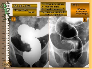 AA BB
*Rx de Colon*Rx de Colon
**Proyección:Proyección:
**Técnica de examen:Técnica de examen:
A-A-
B-B-
**Segmento examinado:Segmento examinado:
E ME M
UNTUNT
*M. C.:*M. C.:
dificultaddificultad
defecatoriadefecatoria
proctorragiaproctorragia
NMNM
N
frentefrente
““relleno total”relleno total”
““doble contraste”doble contraste”
recto y sigmoidesrecto y sigmoides
 
