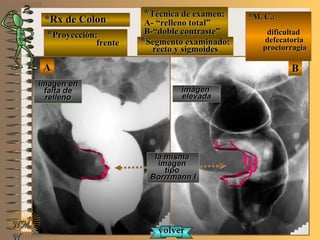 AA BB
*Rx de Colon*Rx de Colon
**Proyección:Proyección:
frentefrente
**Técnica de examen:Técnica de examen:
A- “relleno total”A- “relleno total”
B-“doble contraste”B-“doble contraste”
**Segmento examinado:Segmento examinado:
recto y sigmoidesrecto y sigmoides
E ME M
UNTUNT
*M. C.:*M. C.:
dificultaddificultad
defecatoriadefecatoria
proctorragiaproctorragia
NMNM
N
imagen enimagen en
falta defalta de
rellenorelleno
imagenimagen
elevadaelevada
la mismala misma
imagenimagen
tipotipo
Borrrmann IBorrrmann I
volvervolver
 