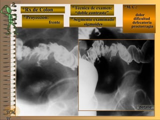 *Rx de Colon*Rx de Colon
**Proyección:Proyección:
**Técnica de examen:Técnica de examen:
**Segmento examinadoSegmento examinado
E ME M
UNTUNT
*M. C.:*M. C.:
dolordolor
dificultaddificultad
defecatoriadefecatoria
proctorragiaproctorragia
NMNM
N
detalledetalle
frentefrente
““doble contraste”doble contraste”
sigmoidessigmoides
 