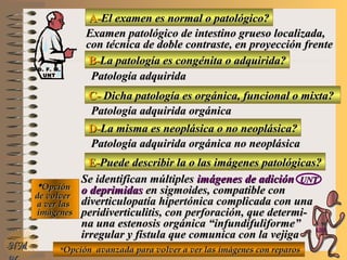 A-A-El examen es normal o patológico?El examen es normal o patológico?
Examen patológico de intestino grueso localizada,Examen patológico de intestino grueso localizada,
con técnica de doble contraste, en proyección frentecon técnica de doble contraste, en proyección frente
B-B-La patología es congénita o adquirida?La patología es congénita o adquirida?
Patología adquiridaPatología adquirida
C-C- Dicha patología es orgánica, funcional o mixta?Dicha patología es orgánica, funcional o mixta?
**OpciónOpción
de volverde volver
a ver lasa ver las
imágenesimágenes
Patología adquirida orgánicaPatología adquirida orgánica
D-D-La misma es neoplásica o no neoplásica?La misma es neoplásica o no neoplásica?
Patología adquirida orgánica no neoplásicaPatología adquirida orgánica no neoplásica
E-E-Puede describir la o las imágenes patológicas?Puede describir la o las imágenes patológicas?
Se identifican múltiplesSe identifican múltiples imágenes de adiciónimágenes de adición UNTUNT
o deprimidaso deprimidas en sigmoides, compatible conen sigmoides, compatible con
diverticulopatía hipertónica complicada con unadiverticulopatía hipertónica complicada con una
peridiverticulitis, con perforación, que determi-peridiverticulitis, con perforación, que determi-
na una estenosis orgánica “infundifuliforme”na una estenosis orgánica “infundifuliforme”
irregular y fístula que comunica con la vejigairregular y fístula que comunica con la vejiga
**Opción avanzada para volver a ver las imágenes con reparosOpción avanzada para volver a ver las imágenes con reparosNMNM
D. F. M.D. F. M.
UNTUNT
E ME M
UNTUNT
 
