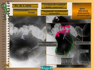 *Rx de Colon*Rx de Colon
**Proyección:Proyección:
frentefrente
**Técnica de examen:Técnica de examen:
““doble contraste”doble contraste”
**Segmento examinadoSegmento examinado
sigmoidessigmoides
E ME M
UNTUNT
*M. C.:*M. C.:
dolordolor
dificultaddificultad
defecatoriadefecatoria
proctorragiaproctorragia
NMNM
N
detalledetalle
fistulafistula
vejigavejiga
con airecon aire
y barioy bario
divertículosdivertículosestenosisestenosis
peridiverticularperidiverticular
volvervolver
 