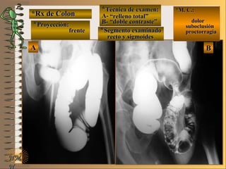 *Rx de Colon*Rx de Colon
**Proyección:Proyección:
**Técnica de examen:Técnica de examen:
A-A-
B-B-
**Segmento examinadoSegmento examinado
E ME M
UNTUNT
*M. C.:*M. C.:
dolordolor
suboclusiónsuboclusión
proctorragiaproctorragia
NMNM
N
AA BB
frentefrente
““relleno total”relleno total”
““doble contraste”doble contraste”
rrecto y sigmoidesecto y sigmoides
 