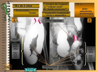 *Rx de Colon*Rx de Colon
**Proyección:Proyección:
frentefrente
**Técnica de examen:Técnica de examen:
A-“relleno total”A-“relleno total”
B-“doble contraste”B-“doble contraste”
**Segmento examinadoSegmento examinado
rrecto y sigmoidesecto y sigmoides
E ME M
UNTUNT
*M. C.:*M. C.:
dolordolor
suboclusiónsuboclusión
proctorragiaproctorragia
NMNM
N
AA BB
sig-sig-
moi-moi-
desdes
her-her-
nia-nia-
dodo
rectorecto
rectorecto
sig-sig-
moi-moi-
desdes
her-her-
nia-nia-
dodo
divertículosdivertículos
volvervolver
anillo inguinalanillo inguinal
 