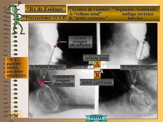 NMNM
*Rx de Esófago*Rx de Esófago
**Proyecciones: O.A.D.Proyecciones: O.A.D.
**Técnica de examen:Técnica de examen:
A-“relleno total”A-“relleno total”
B-”doble contraste”B-”doble contraste”
**Segmento examinado:Segmento examinado:
esófago toráxicoesófago toráxico
inferiorinferior
*M. C.:*M. C.:
pacientepaciente
adultoadulto
con dolorcon dolor
epigástricoepigástrico
AA
BB
volvervolver
relleno totalrelleno total
doble contrastedoble contraste
ulcera:ulcera:
imagenimagen
de adiciónde adición
ulcera:ulcera:
imagenimagen
deprimidadeprimida
E ME M
UNTUNT
la misma imagenla misma imagen la misma imagenla misma imagen
 