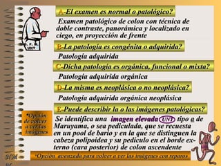 A-A-El examen es normal o patológico?El examen es normal o patológico?
Examen patológico de colon con técnica deExamen patológico de colon con técnica de
doble contraste, panorámica y localizado endoble contraste, panorámica y localizado en
ciego, en proyección de frenteciego, en proyección de frente
B-B-La patología es congénita o adquirida?La patología es congénita o adquirida?
Patología adquiridaPatología adquirida
D-D-La misma es neoplásica o no neoplásica?La misma es neoplásica o no neoplásica?
**OpciónOpción
de volverde volver
a ver lasa ver las
imágenesimágenes
Patología adquirida orgánica neoplásicaPatología adquirida orgánica neoplásica
E-E-Puede describir la o las imágenes patológicas?Puede describir la o las imágenes patológicas?
Se identifica unaSe identifica una imagen elevadaimagen elevada UNTUNT tipotipo aa dede
Maruyama, o sea pediculada, que se recuestaMaruyama, o sea pediculada, que se recuesta
en un pool de bario y en la que se distinguen laen un pool de bario y en la que se distinguen la
cabeza polipoidea y su pedículo en el borde ex-cabeza polipoidea y su pedículo en el borde ex-
terno (cara posterior) de colon ascendenteterno (cara posterior) de colon ascendente
NMNM
C-C-Dicha patología es orgánica, funcional o mixta?Dicha patología es orgánica, funcional o mixta?
Patología adquirida orgánicaPatología adquirida orgánica
**Opción avanzada para volver a ver las imágenes con reparosOpción avanzada para volver a ver las imágenes con reparos
D. F. M.D. F. M.
UNTUNT
E ME M
UNTUNT
 