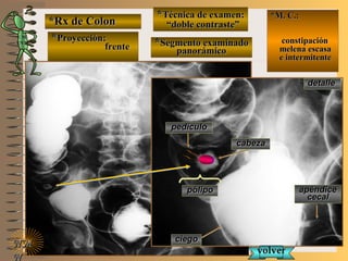 detalledetalle
*Rx de Colon*Rx de Colon
**Proyección:Proyección:
frentefrente
**Técnica de examen:Técnica de examen:
““doble contraste”doble contraste”
**Segmento examinadoSegmento examinado
panorámicopanorámico
E ME M
UNTUNT
*M. C.:*M. C.:
constipaciónconstipación
melena escasamelena escasa
e intermitentee intermitente
NMNM
N
ciegociego
apéndiceapéndice
cecalcecal
pólipopólipo
pedículopedículo
cabezacabeza
volvervolver
 