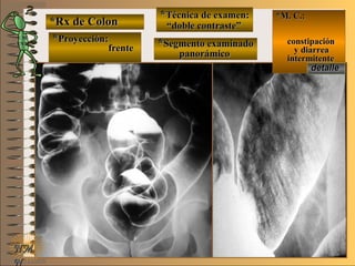 *Rx de Colon*Rx de Colon
**Proyección:Proyección:
**Técnica de examen:Técnica de examen:
**Segmento examinadoSegmento examinado
E ME M
UNTUNT
*M. C.:*M. C.:
constipaciónconstipación
y diarreay diarrea
intermitenteintermitente
NMNM
N
detalledetalle
frentefrente
““doble contraste”doble contraste”
panorámicopanorámico
 