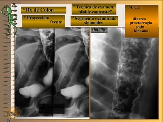*Rx de Colon*Rx de Colon
**Proyección:Proyección:
**Técnica de examen:Técnica de examen:
**Segmento examinadoSegmento examinadoE ME M
UNTUNT
*M. C.:*M. C.:
diarreadiarrea
proctorragiaproctorragia
pujopujo
tenesmotenesmo
NMNM
N
detalledetalle
frentefrente
““doble contraste”doble contraste”
sigmoidessigmoides
 