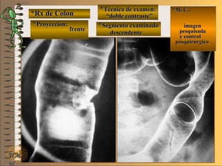 *Rx de Colon*Rx de Colon
**Proyección:Proyección:
**Técnica de examen:Técnica de examen:
**Segmento examinadoSegmento examinadoE ME M
UNTUNT
*M. C.:*M. C.:
imagenimagen
pesquisadapesquisada
y controly control
posquirúrgicoposquirúrgico
NMNM
N
frentefrente
““doble contraste”doble contraste”
descendentedescendente
 