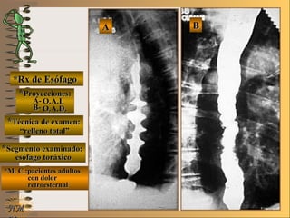 BBE ME M
UNTUNT
NMNM
*Rx de Esófago*Rx de Esófago
**Proyecciones:Proyecciones:
A-A-
B-B-
**Técnica de examen:Técnica de examen:
**Segmento examinado:Segmento examinado:
*M. C.:pacientes adultos*M. C.:pacientes adultos
con dolorcon dolor
retroesternalretroesternal
AA
O.A.I.O.A.I.
O.A.D.O.A.D.
““relleno total”relleno total”
esófago toráxicoesófago toráxico
 