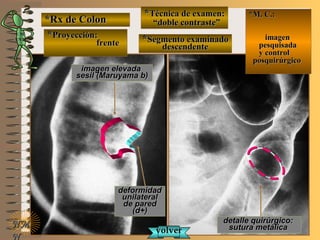 imagen elevadaimagen elevada
sesil (Maruyama b)sesil (Maruyama b)
*Rx de Colon*Rx de Colon
**Proyección:Proyección:
frentefrente
**Técnica de examen:Técnica de examen:
““doble contraste”doble contraste”
E ME M
UNTUNT
NMNM
N
detalle quirúrgico:detalle quirúrgico:
sutura metálicasutura metálica
**Segmento examinadoSegmento examinado
descendentedescendente
*M. C.:*M. C.:
imagenimagen
pesquisadapesquisada
y controly control
posquirúrgicoposquirúrgico
deformidaddeformidad
unilateralunilateral
de paredde pared
(d+)(d+)
volvervolver
 