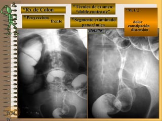 *Rx de Colon*Rx de Colon
**Proyección:Proyección:
**Técnica de examen:Técnica de examen:
**Segmento examinadoSegmento examinado
E ME M
UNTUNT
*M. C.:*M. C.:
dolordolor
constipaciónconstipación
distensióndistensión
NMNM
N
detalledetalle
frentefrente
““doble contraste”doble contraste”
panorámicapanorámica
 