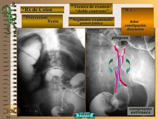 *Rx de Colon*Rx de Colon
**Proyección:Proyección:
frentefrente
**Técnica de examen:Técnica de examen:
““doble contraste”doble contraste”
**Segmento examinadoSegmento examinado
panorámicapanorámica
E ME M
UNTUNT
*M. C.:*M. C.:
dolordolor
constipaciónconstipación
distensióndistensión
NMNM
N
detalledetalle
compresióncompresión
extrínsecaextrínseca
plieguespliegues
volvervolver
 