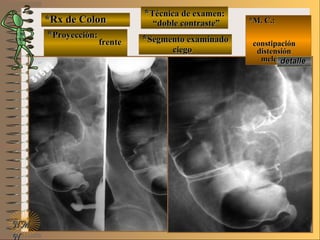 *Rx de Colon*Rx de Colon
**Proyección:Proyección:
**Técnica de examen:Técnica de examen:
**Segmento examinadoSegmento examinado
E ME M
UNTUNT
*M. C.:*M. C.:
constipaciónconstipación
distensióndistensión
melenamelena
NMNM
N
detalledetalle
frentefrente
““doble contraste”doble contraste”
ciegociego
 