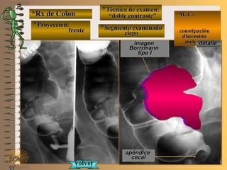 *Rx de Colon*Rx de Colon
**Proyección:Proyección:
frentefrente
**Técnica de examen:Técnica de examen:
““doble contraste”doble contraste”
**Segmento examinadoSegmento examinado
ciegociego
E ME M
UNTUNT
*M. C.:*M. C.:
constipaciónconstipación
distensióndistensión
melenamelena
NMNM
N
detalledetalleimagenimagen
BorrrmannBorrrmann
tipo Itipo I
apéndiceapéndice
cecalcecal
volvervolver
 