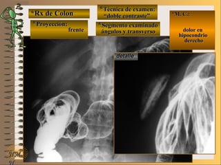 *Rx de Colon*Rx de Colon
**Proyección:Proyección:
**Técnica de examen:Técnica de examen:
**Segmento examinadoSegmento examinadoE ME M
UNTUNT
*M. C.:*M. C.:
dolor endolor en
hipocondriohipocondrio
derechoderecho
NMNM
N
detalledetalle
frentefrente
““doble contraste”doble contraste”
ángulos y transversoángulos y transverso
 