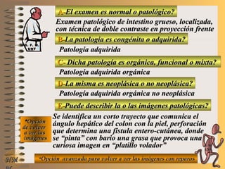 A-A-El examen es normal o patológico?El examen es normal o patológico?
Examen patológico de intestino grueso, localizada,Examen patológico de intestino grueso, localizada,
con técnica de doble contraste en proyección frentecon técnica de doble contraste en proyección frente
B-B-La patología es congénita o adquirida?La patología es congénita o adquirida?
Patología adquiridaPatología adquirida
C-C- Dicha patología es orgánica, funcional o mixta?Dicha patología es orgánica, funcional o mixta?
**OpciónOpción
de volverde volver
a ver lasa ver las
imágenesimágenes
Patología adquirida orgánicaPatología adquirida orgánica
D-D-La misma es neoplásica o no neoplásica?La misma es neoplásica o no neoplásica?
Patología adquirida orgánica no neoplásicaPatología adquirida orgánica no neoplásica
E-E-Puede describir la o las imágenes patológicas?Puede describir la o las imágenes patológicas?
Se identifica un corto trayecto que comunica elSe identifica un corto trayecto que comunica el
ángulo hepático del colon con la piel, perforaciónángulo hepático del colon con la piel, perforación
que determina una fístula entero-cutánea, dondeque determina una fístula entero-cutánea, donde
se “pinta” con bario una grasa que provoca unase “pinta” con bario una grasa que provoca una
curiosa imagen en “platillo volador”curiosa imagen en “platillo volador”
**Opción avanzada para volver a ver las imágenes con reparosOpción avanzada para volver a ver las imágenes con reparosNMNM
D. F. M.D. F. M.
UNTUNT
E ME M
UNTUNT
 